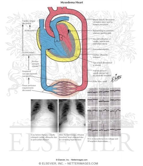 Heart in Myxedema