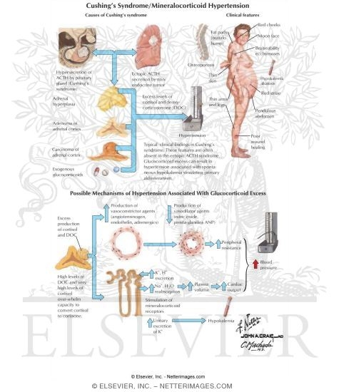 Cushing S Syndrome And Mineralocorticoid Hypertension