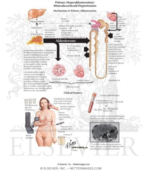 Watermarked preview of labeled image: Primary Hyperaldosteronism and Mineralocorticoid Hypertension