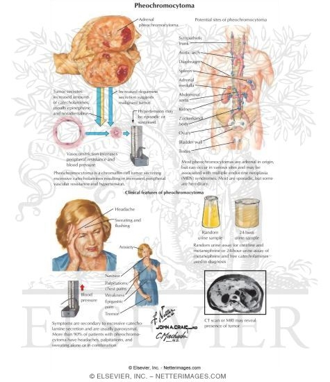 Pheochromocytoma