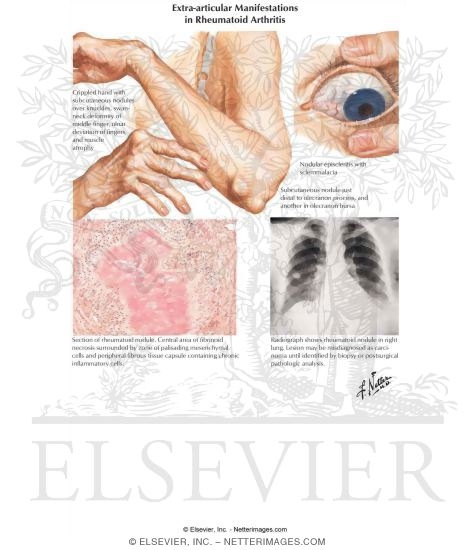 Extra-articular Manifestations in Rheumatoid Arthritis