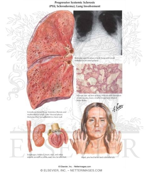 Progressive Systemic Sclerosis (PSS; Scleroderma); Lung Involvement