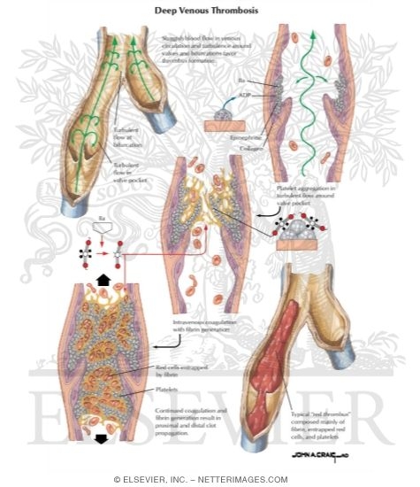 Watermarked preview of labeled image: Venous Thrombosis