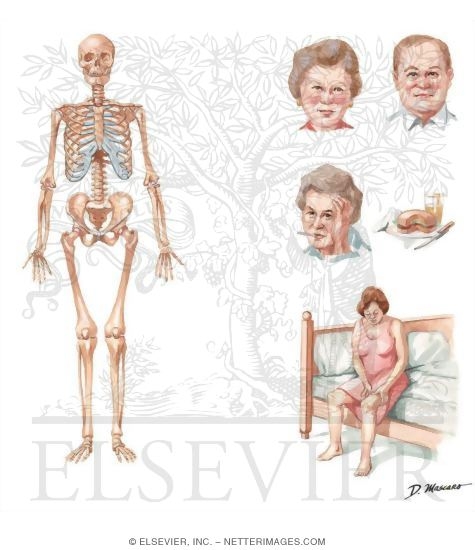 Clinical Presentation In Rheumatoid Arthritis