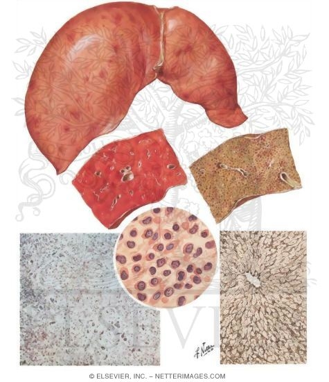 Viral Hepatitis: Fulminant Form (Acute Massive Necrosis)