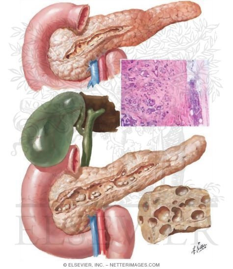 Chronic (Relapsing) Pancreatitis