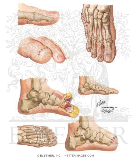 Amputation of Foot