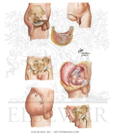 Hindquarter Amputation (Hemipelvectomy)
Disarticulation of Hip