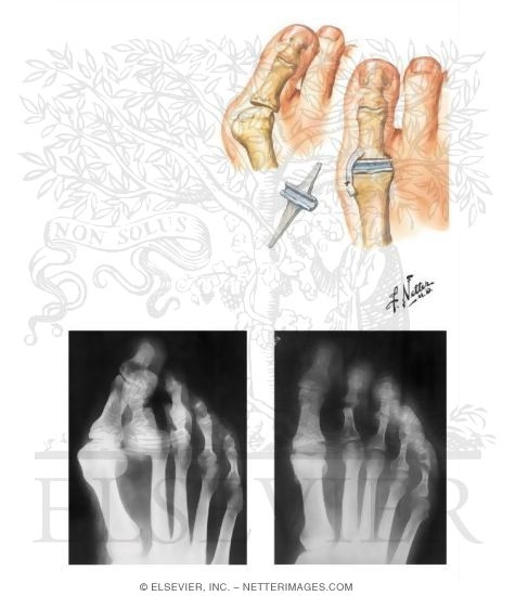 Flexible Implant Resection Arthroplasty for Disabilities of Great Toe