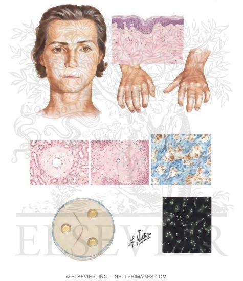 Watermarked preview of unlabeled image: Progressive Systemic Sclerosis (Scleroderma) and Rheumatoid Arthritis