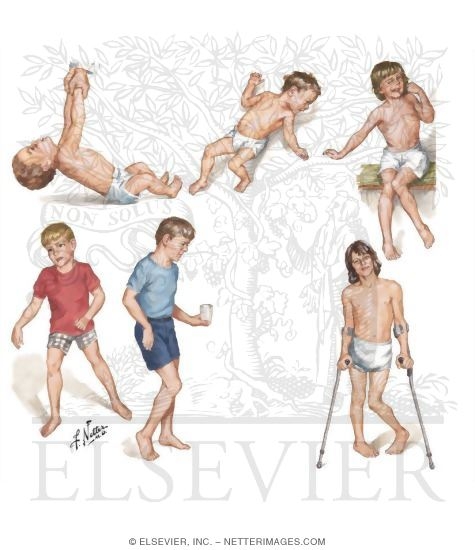 Watermarked preview of unlabeled image: Cerebral Palsy