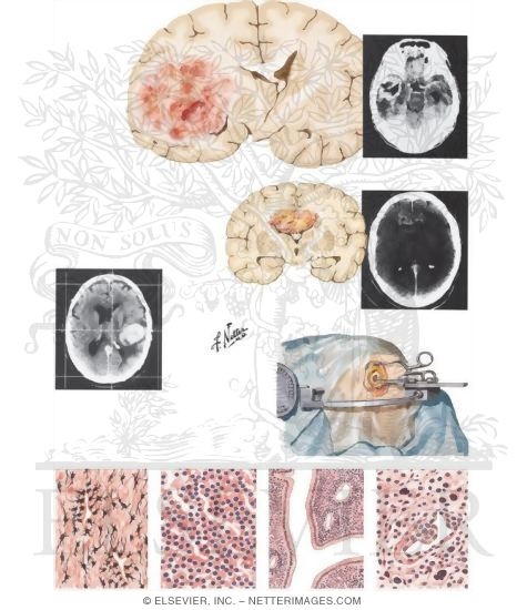 Watermarked preview of unlabeled image: Gliomas