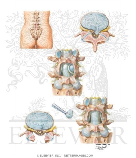 Watermarked preview of unlabeled image: Laminectomy and Discectomy