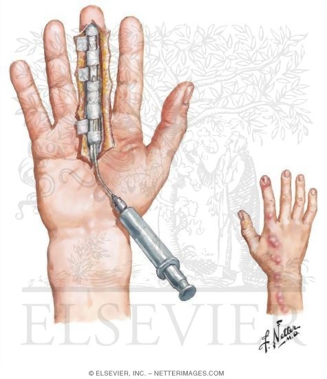 Tenosynovitis and Infection of Fascial Space