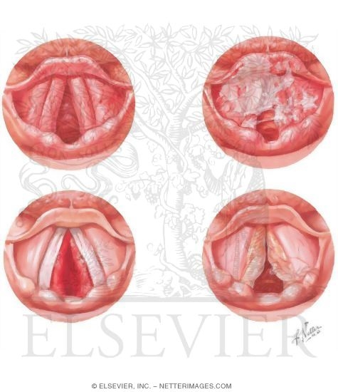 Inflammation of the Larynx