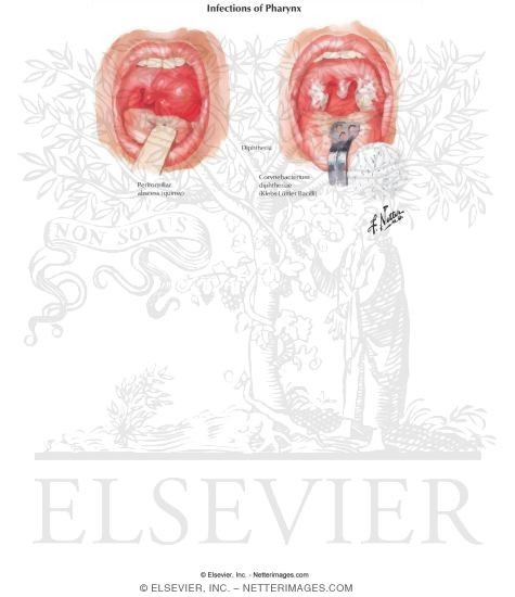 Watermarked preview of labeled image: Infections of Pharynx