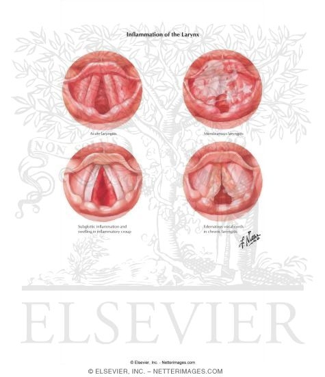 Inflammation of the Larynx