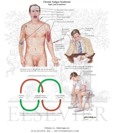 Chronic Fatigue Syndrome