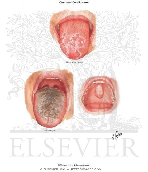 Watermarked preview of labeled image: Common Oral Lesions