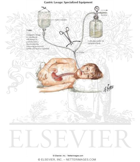 Watermarked preview of labeled image: Gastric Lavage: Specialized Equipment