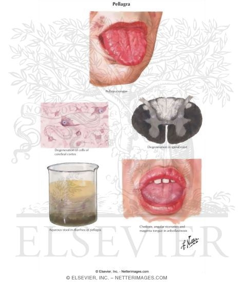 Pellagra