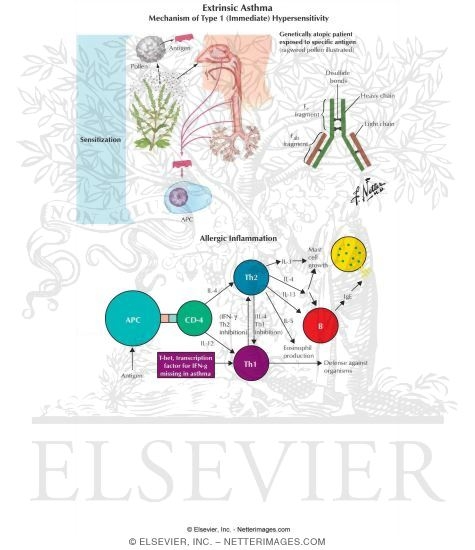 Extrinsic Asthma
