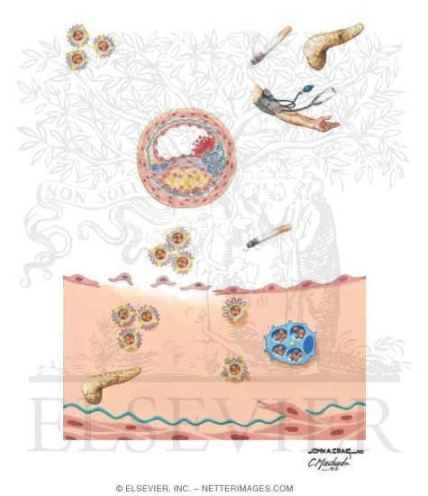Watermarked preview of unlabeled image: Hypercholesterolemia As Risk Factor In Coronary Artery Disease