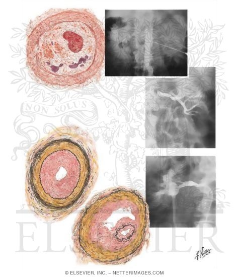 Watermarked preview of unlabeled image: Occlusive Disease of Main Renal Artery