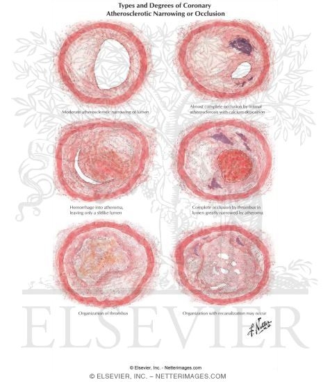 Watermarked preview of labeled image: Pathologic Changes In Coronary Artery Disease
Types and Degrees of Coronary Atherosclerotic Narrowing Or Occlusion