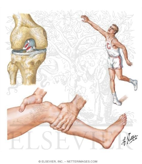 Rupture of Anterior Cruciate Ligament