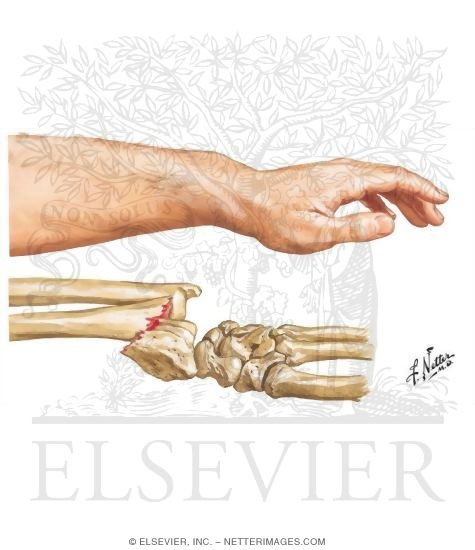 Flexion - Compression (Smith's) Fracture