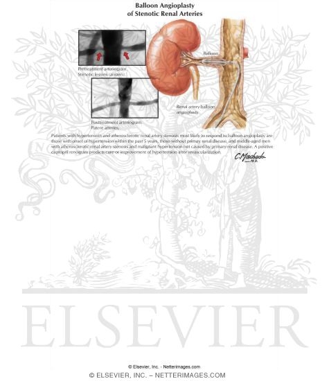 Watermarked preview of labeled image: Balloon Angioplasty of Stenotic Renal Arteries