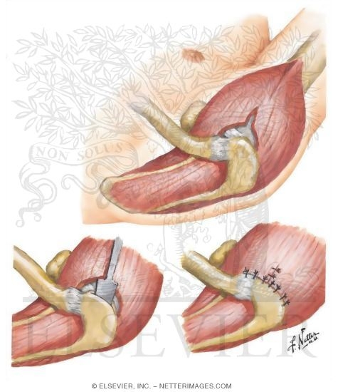 Open Acromioplasty (Partial Acromionectomy)