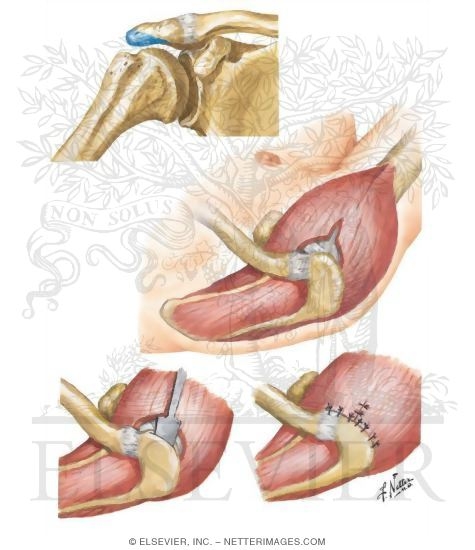 Watermarked preview of unlabeled image: Open Acromioplasty (Partial Acromionectomy)
