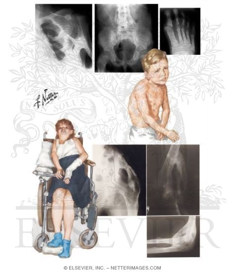 Fibrodysplasia (Myositis) Ossificans Progressiva