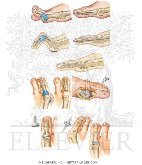 Surgical Procedures for Toe Deformities