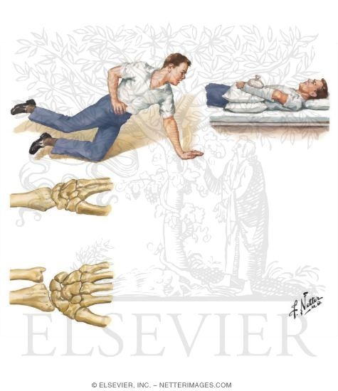 Extension / Compression Fracture of Distal Radius (Colles Fracture)