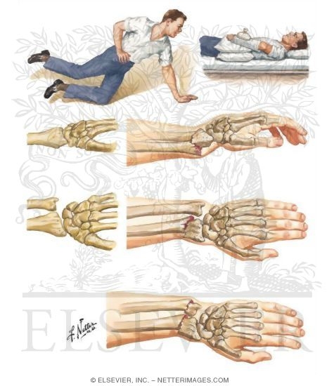 Extension/Compression Fracture of Distal Radius (Colles Fracture)