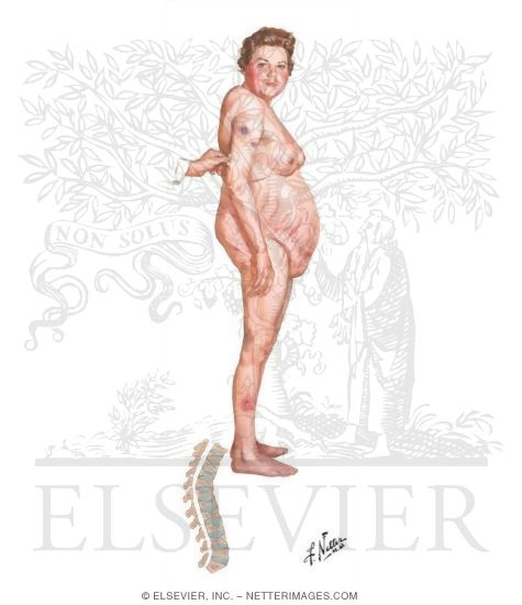 Cushing's Syndrome: Clinical Findings