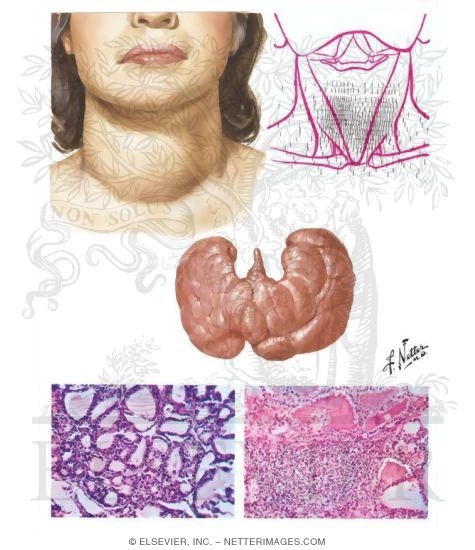 Thyroid Pathology in Graves Disease