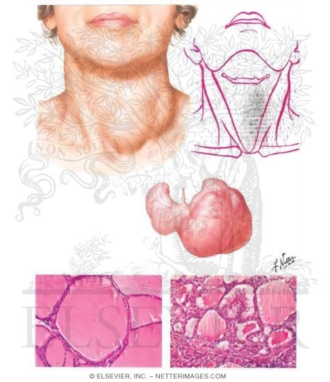 Illustration of Pathophysiology of Hyperfunctioning Thyroid Adenoma from the Netter Collection