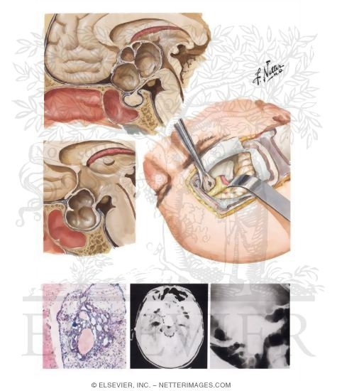 Watermarked preview of unlabeled image: Craniopharyngiomas