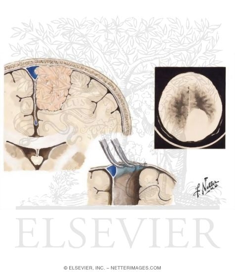 Meningiomas