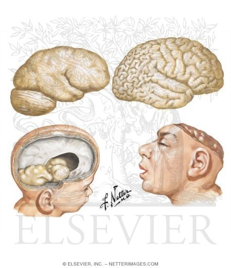 Watermarked preview of unlabeled image: Brain Malformations