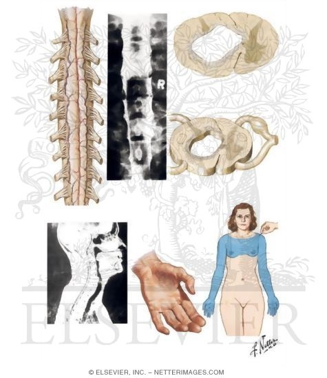 Watermarked preview of unlabeled image: Syringomyelia