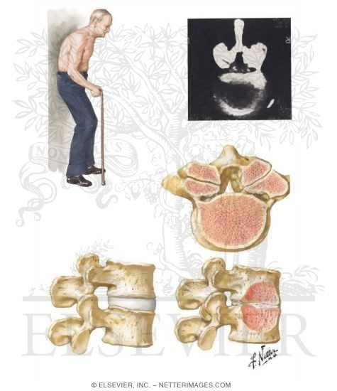 Watermarked preview of unlabeled image: Spinal Stenosis