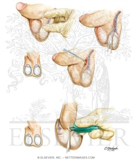 Vasectomy