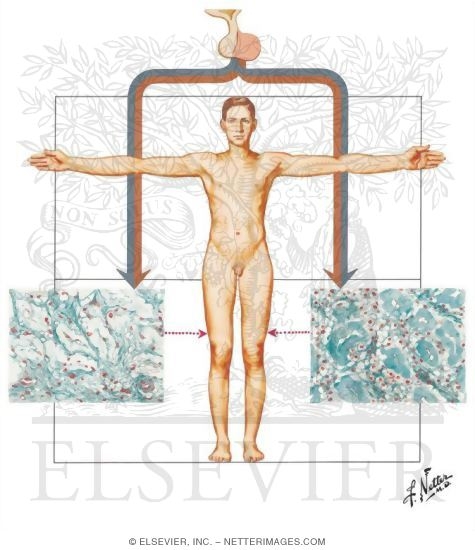 Klinefelter's Syndrome