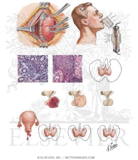 Watermarked preview of unlabeled image: Causes of Adult Myxedema