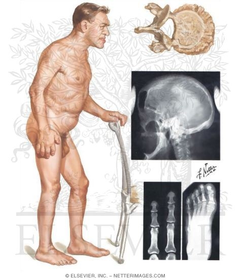 Acromegaly